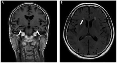 Missense mutation of angiotensin converting enzyme gene in an Alzheimer’s disease patient: a case report